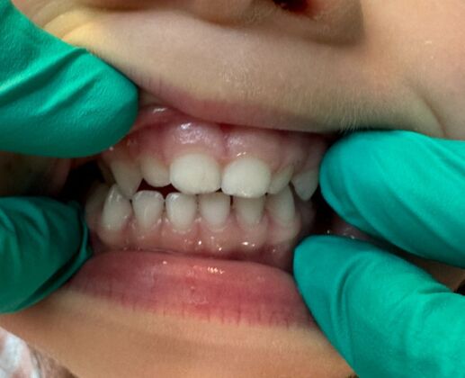 Invisalign Case 9 - After