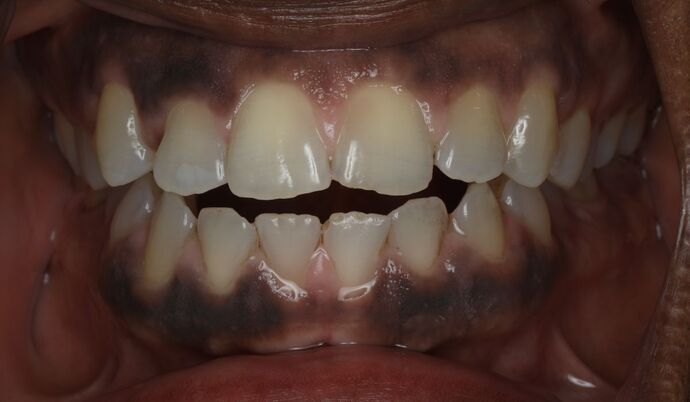Invisalign Case 10 - Before