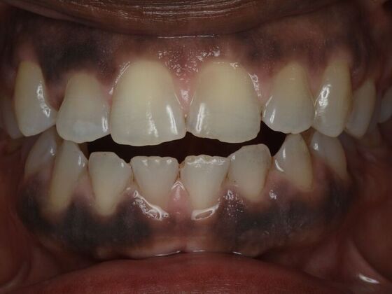 Invisalign Case 10 - Before