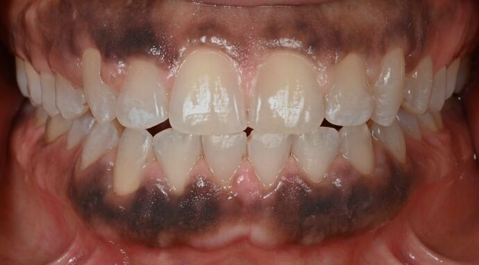 Invisalign Case 10 - After