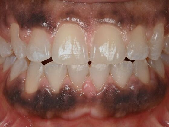 Invisalign Case 10 - After