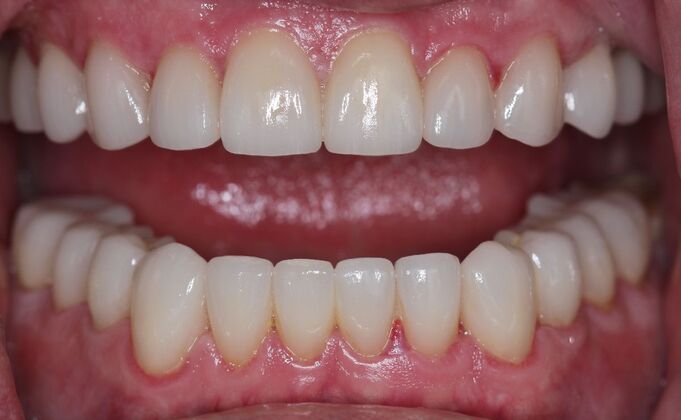 Veneers Cases
