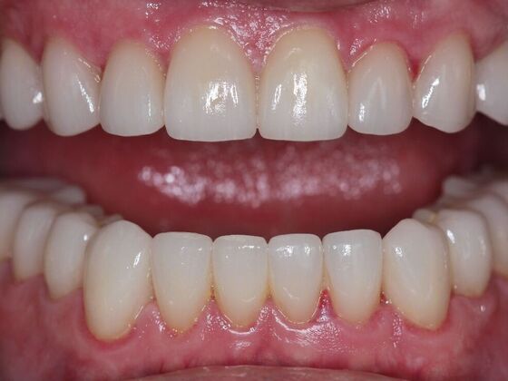 Veneers Case 1 - After