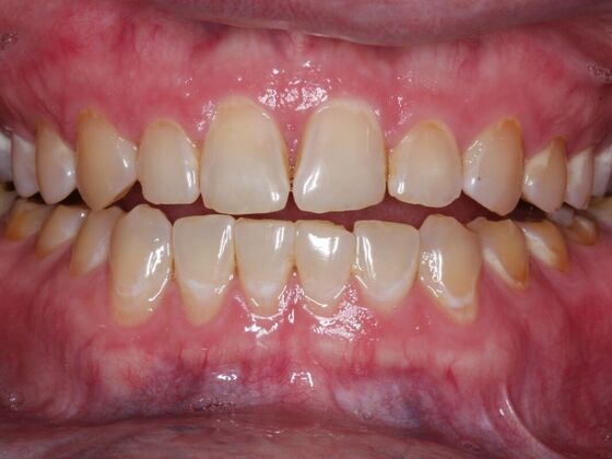 Veneers Case 1 - Before