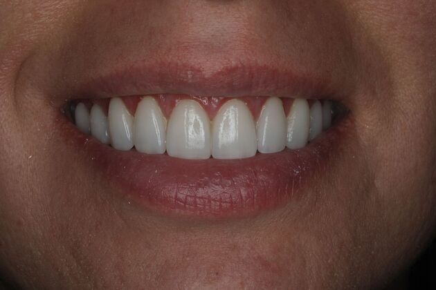 Veneers Case 2 - After
