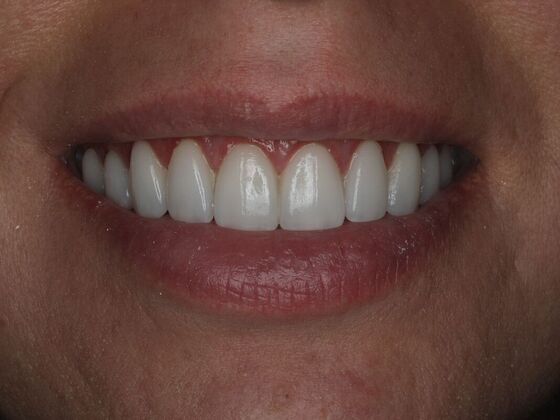 Veneers Case 2 - After