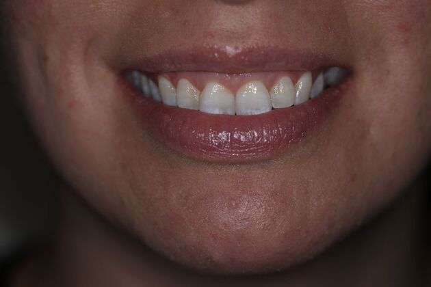 Veneers Case 2 - Before