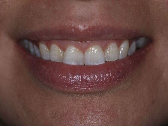 Veneers Case 2 - Before