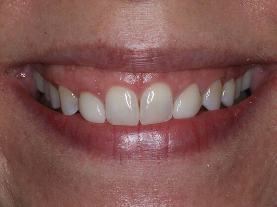 Veneers Case 3 - Before