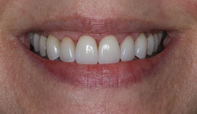 Veneers Case 3 - After