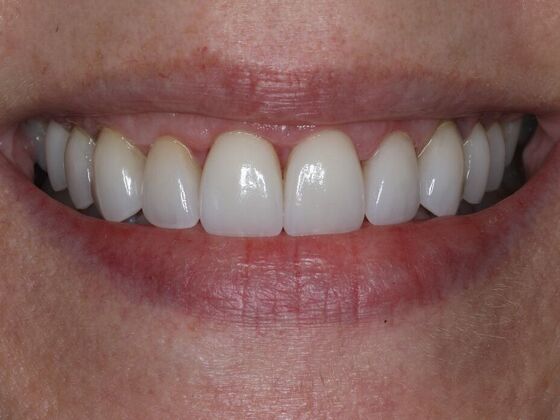 Veneers Cases