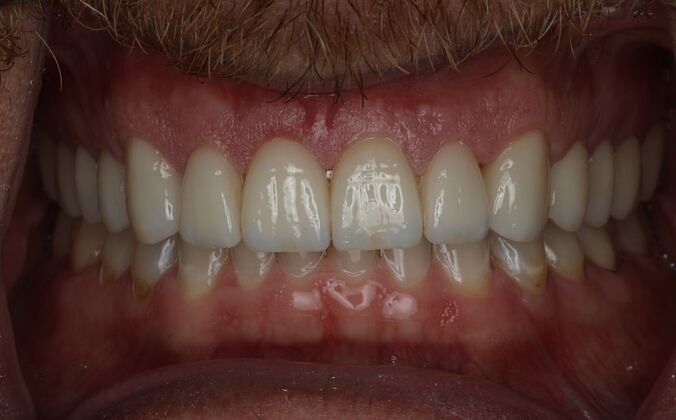 Veneers Case 4 - After