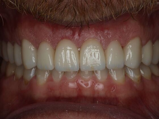 Veneers Case 4 - After
