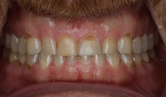 Veneers Case 4 - Before