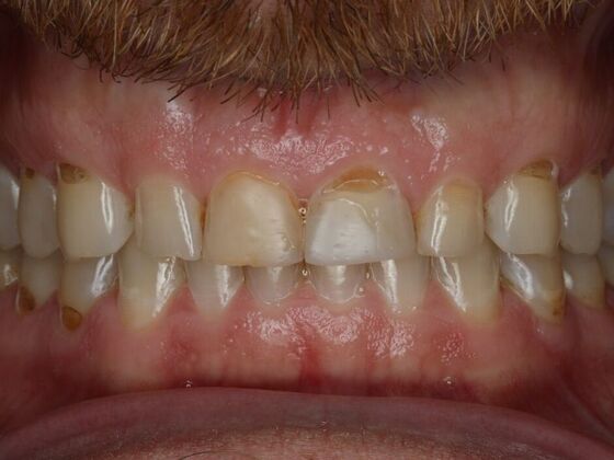 Veneers Case 4 - Before