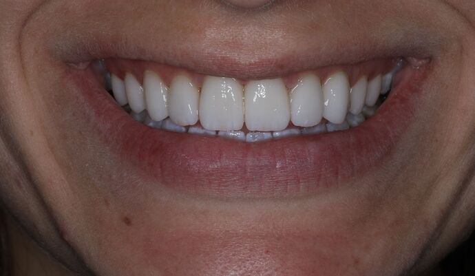 Veneers Case 5 - After