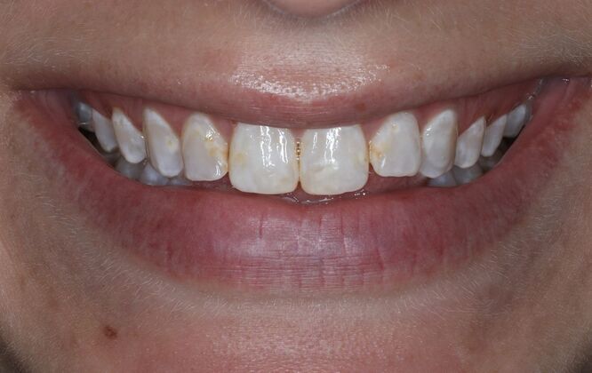 Veneers Case 5 - Before