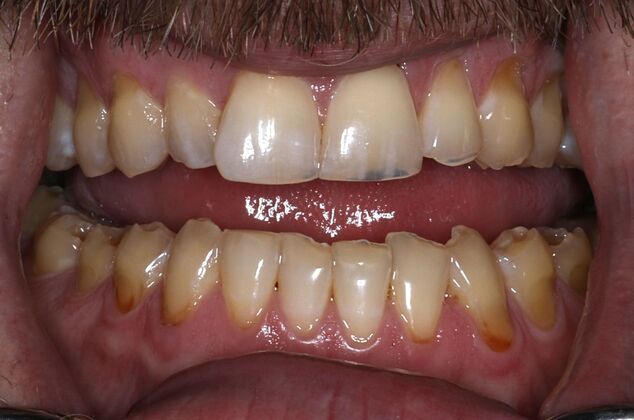 Veneers Case 6 - Before