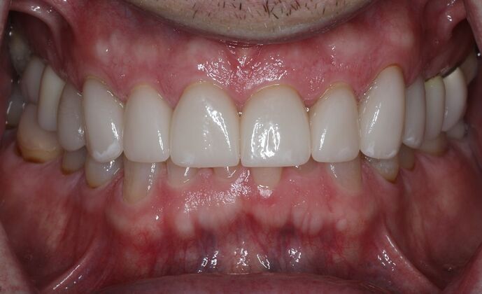 Veneers Case 7 - After