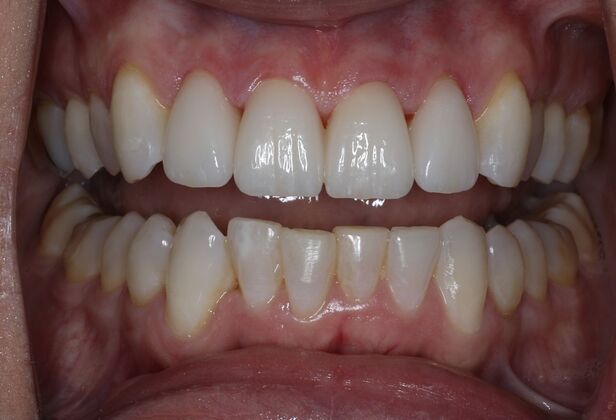 Veneers Case 8 - After