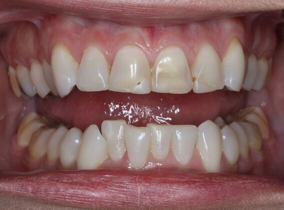 Veneers Case 8 - Before