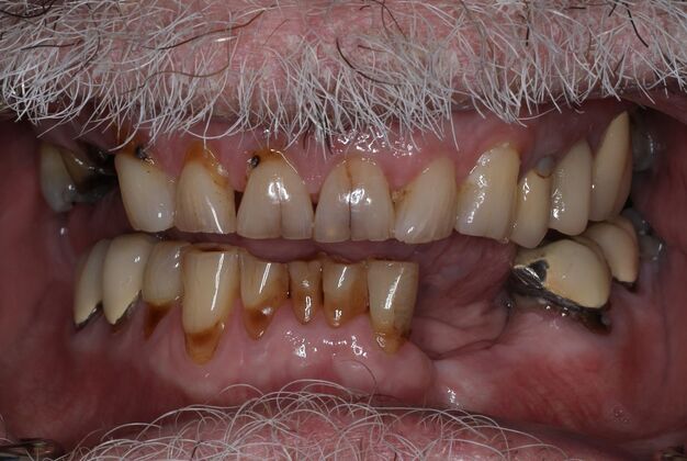 Veneers Case 9 - Before