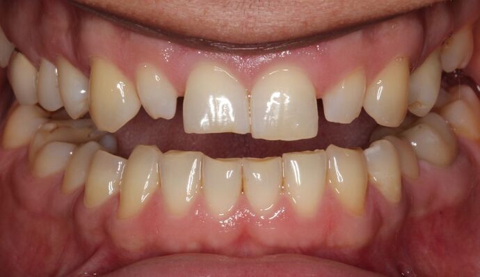 Veneers Case 10 - Before