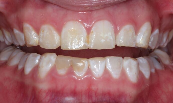 Veneers Case 12 - Before