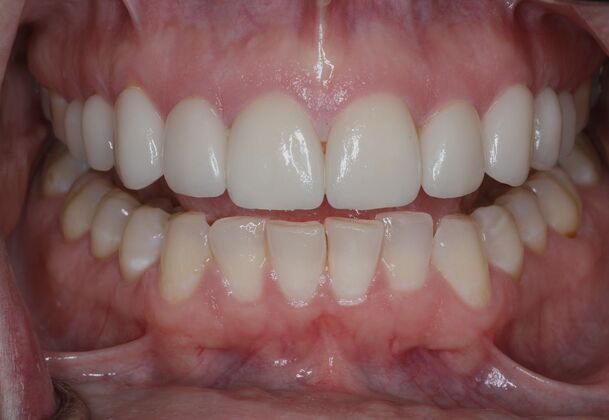 Veneers Case 13 - After