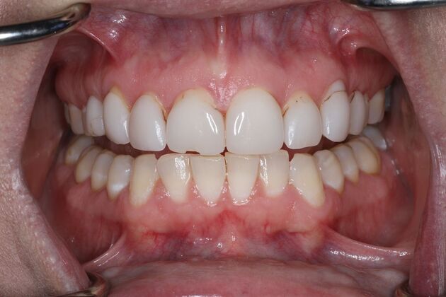 Veneers Case 13 - Before