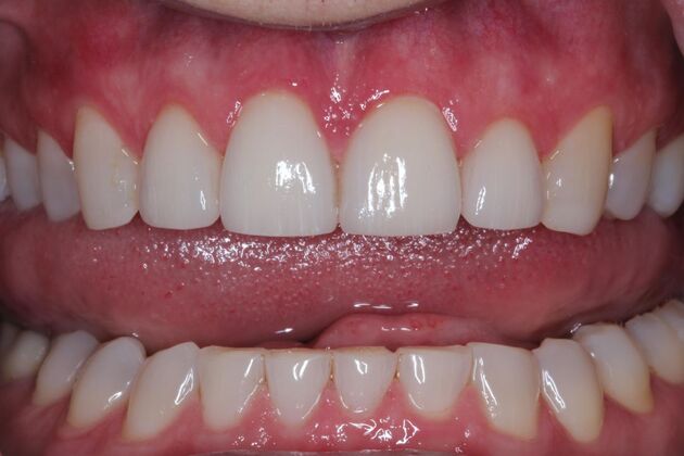 Veneers Case 14 - After