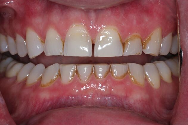 Veneers Case 14 - Before
