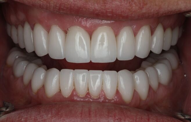 Veneers Case 15 - After