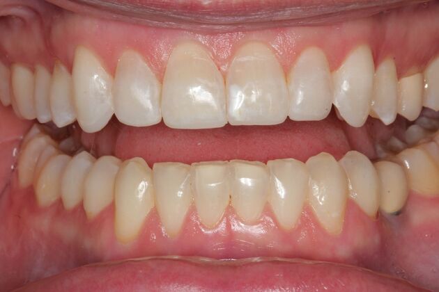 Veneers Case 16 - After