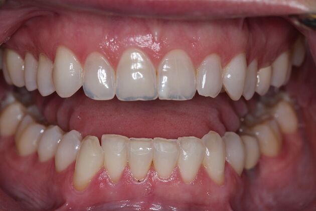 Veneers Case 16 - Before