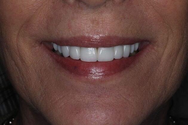Veneers Case 17 - After
