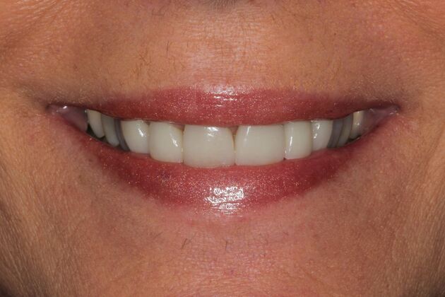 Veneers Case 17 - Before