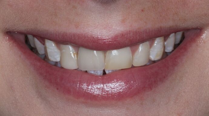 Veneers Case 18 - Before