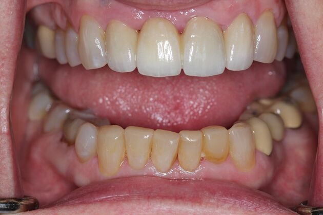 Veneers Case 19 - After