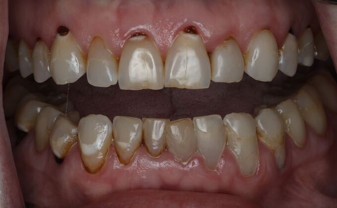Veneers Case 20 - Before