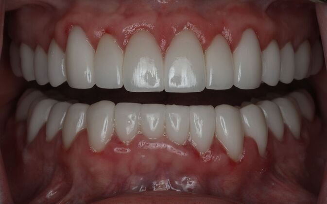 Veneers Case 20 - After