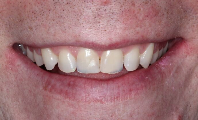 Veneers Case 21 - Before
