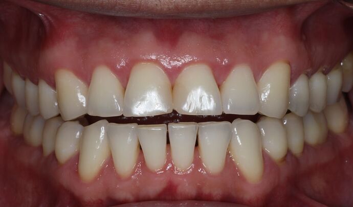 Veneers Case 22 - Before