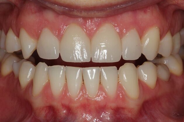 Veneers Case 23 - After