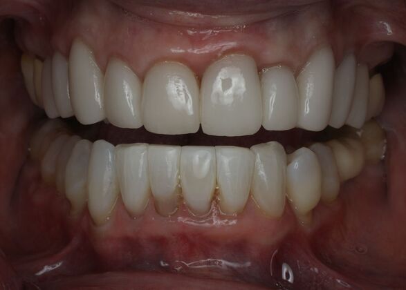 Veneers Case 24 - After