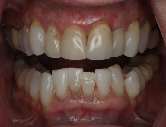 Veneers Case 24 - Before