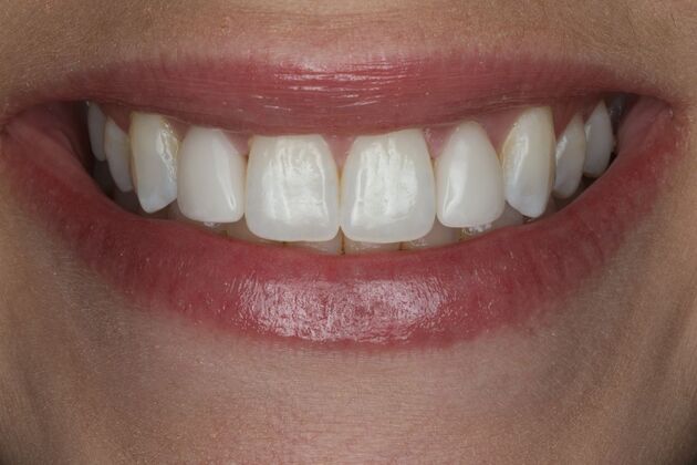 Veneers Case 25 - After