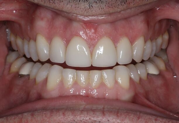 Veneers Case 26 - After