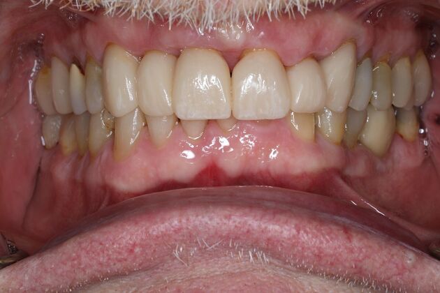 Veneers Case 27 - After