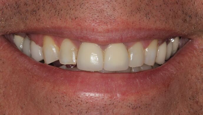 Veneers Case 28 - Before